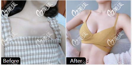 北京韩啸给我做的棉花糖丰胸案例效果图