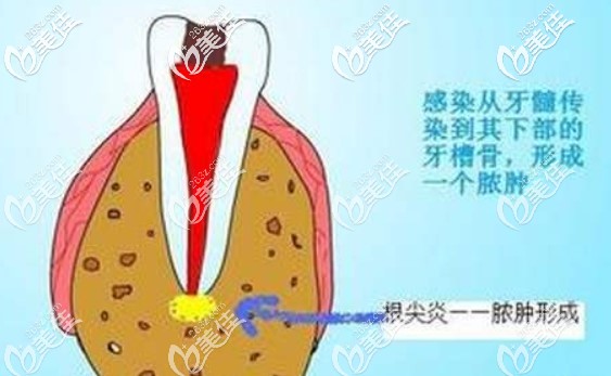 美奥口腔陆明明医生见解龋齿的发展过程