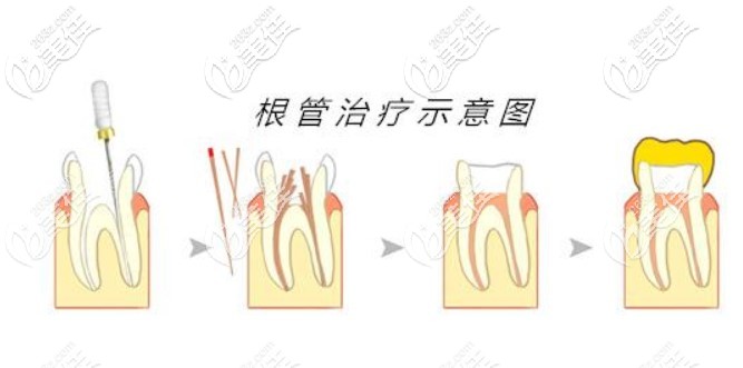 根管治疗过程中痛是正常的吗