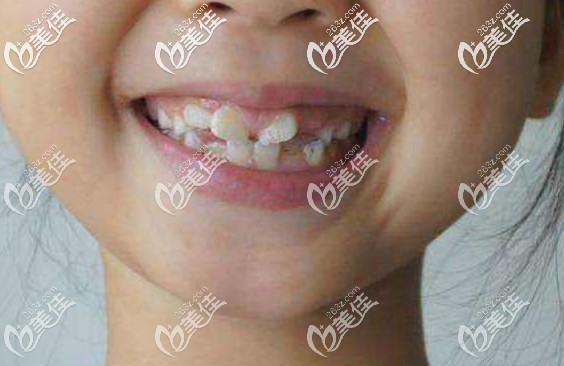 南通美奥口腔王文媛医生建议孩子牙齿畸形越早矫正越好