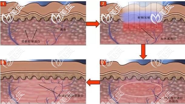 射频紧肤的作用原理