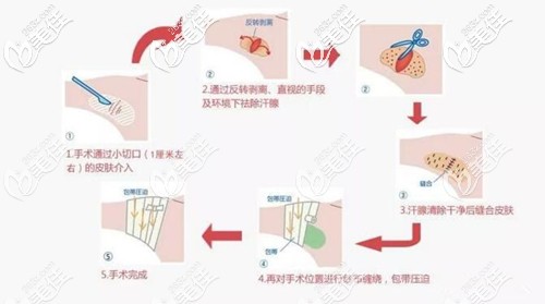 微创祛腋臭过程 微创祛腋臭过程