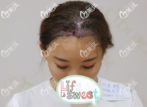 发际线种植术后即刻效果 发际线种植术后即刻效果