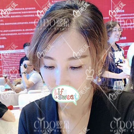 发际线种植1年效果图 发际线种植1年效果图