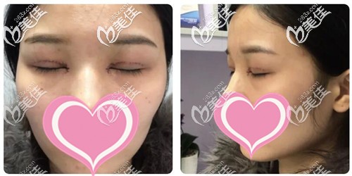 双眼皮+开眼角手术后第三天恢复效果