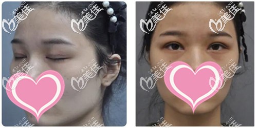 割完双眼皮15天的照片