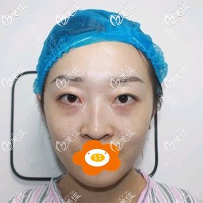 祛眼袋手术前我的照片 祛眼袋手术前我的照片