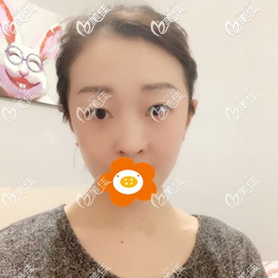 内切祛眼袋术后半个月效果 内切祛眼袋术后半个月效果