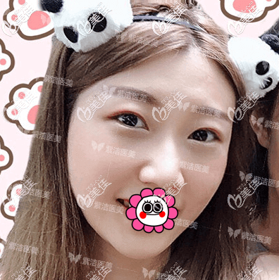 不开刀祛眼袋28天样子