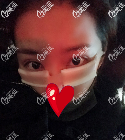 西安艺星去眼袋手术后当天照片 西安艺星去眼袋手术后当天照片