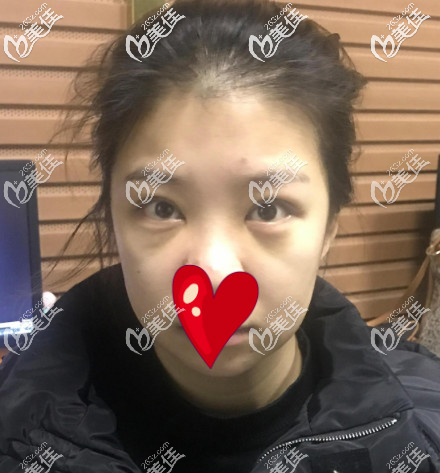 西安艺星去眼袋手术后第五天的样子 西安艺星去眼袋手术后第五天的样子