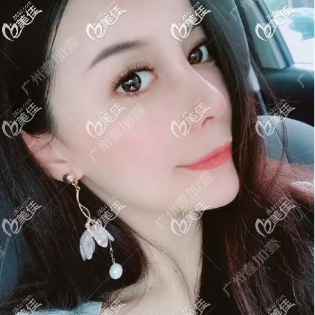 肋软骨隆鼻一个月恢复效果