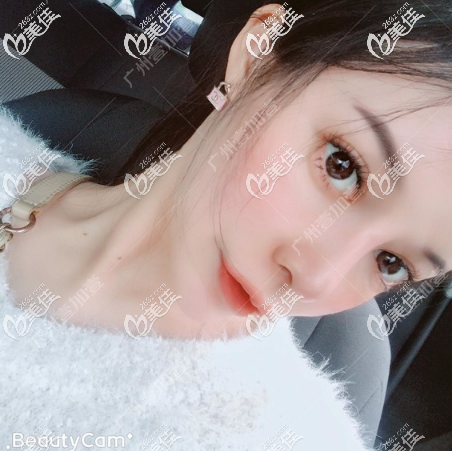 广州壹加壹李明做鼻子怎么样