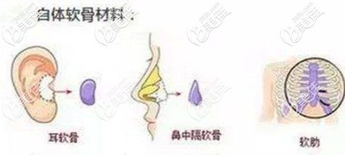 三种自体软骨隆鼻材料