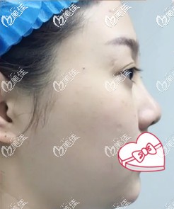 术前我的脸比较大还肥 术前我的脸比较大还肥