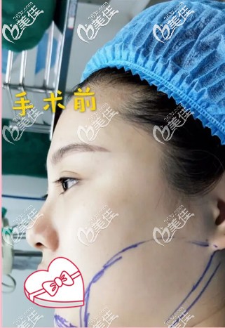 陈誉华院长为我做术前设计 陈誉华院长为我做术前设计