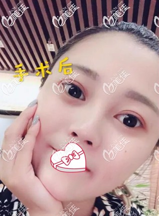 看到术后第五天脸越来越肿挺后悔做面部光纤溶脂的 谁知恢复22天就告别了嘟嘟肉脸