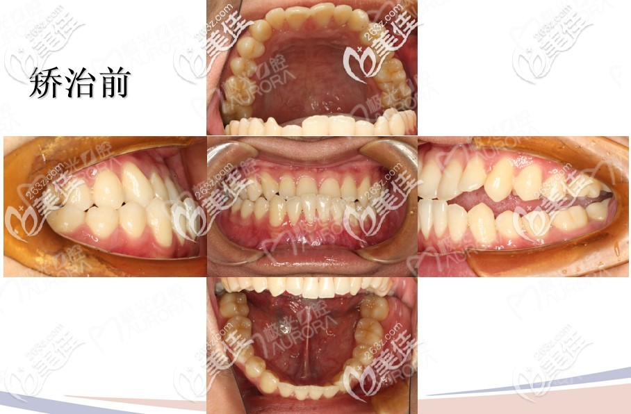 在成都极光口腔矫正地包天前牙齿情况