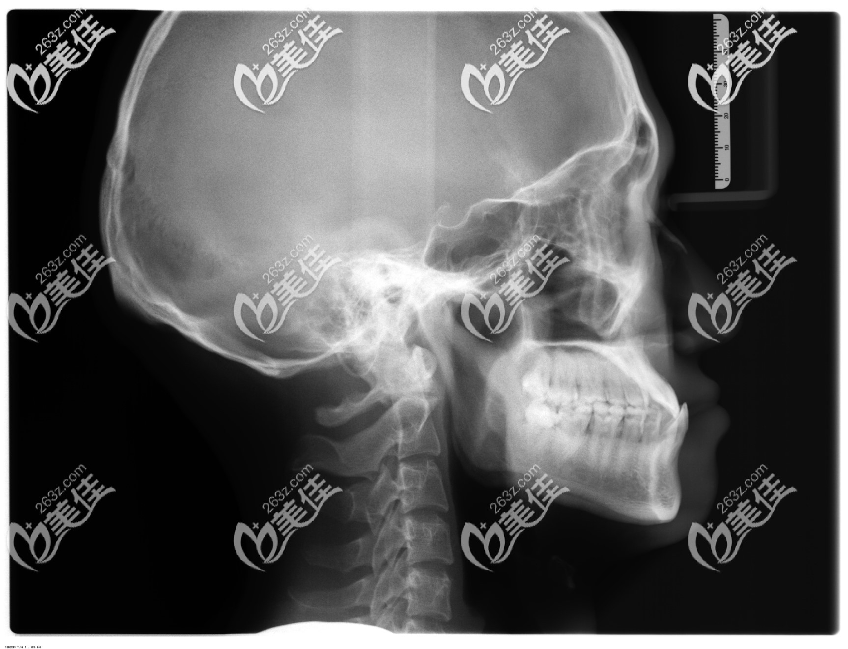 骨性地包天矫正前拍的口腔头颅侧位片