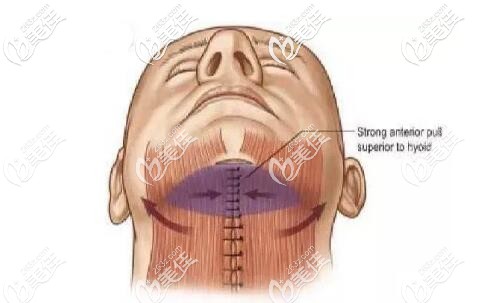 颈阔肌成形术原理 颈阔肌成形术原理