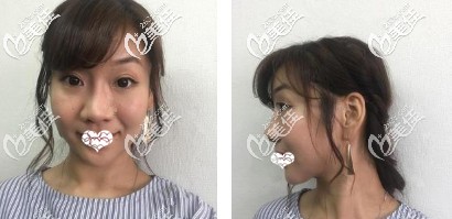 术前鼻子宽大 术前鼻子宽大