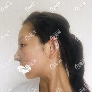刚做完自体软骨隆鼻术后鼻子肿胀 刚做完自体软骨隆鼻术后鼻子肿胀