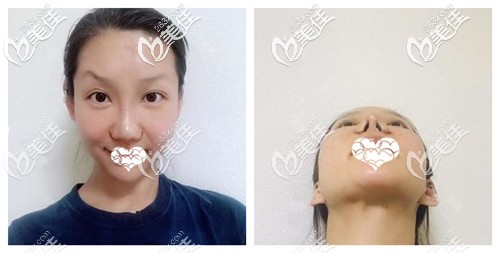 鼻综合术后10天鼻子拆线 鼻综合术后10天鼻子拆线