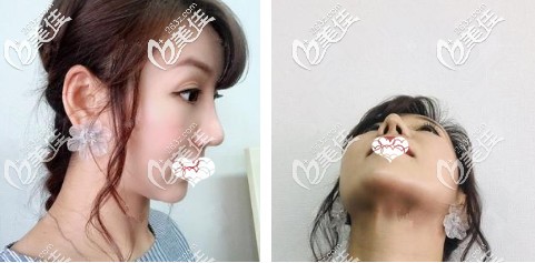 综合鼻整形术后鼻子微肿 综合鼻整形术后鼻子微肿