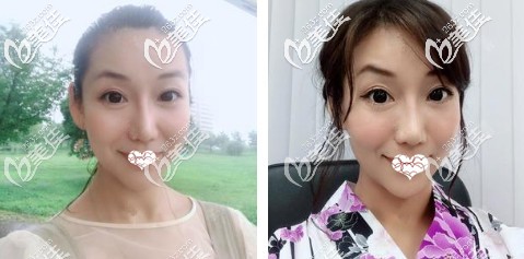 自体软骨隆鼻术后1个月完全消肿 自体软骨隆鼻术后1个月完全消肿