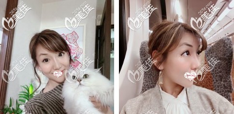 你们所担心的自体软骨隆鼻后会变弯曲、移位、露鼻孔问题 找酒井直彦做鼻综合是不存在的