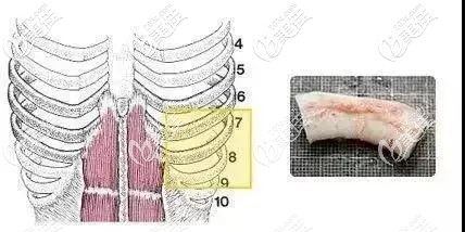 肋软骨隆鼻是否会弯曲的详细说明
