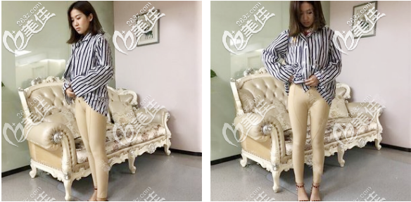 在佛山华美做完大腿吸脂4天图片 在佛山华美做完大腿吸脂4天图片