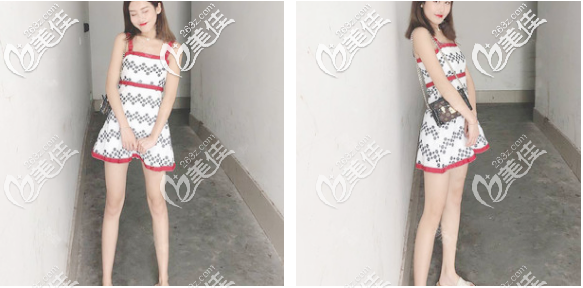 看佛山华美梁宗建大腿吸脂效果怎么样 看佛山华美梁宗建大腿吸脂效果怎么样