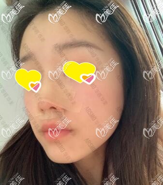 鼻整形术后1周效果图