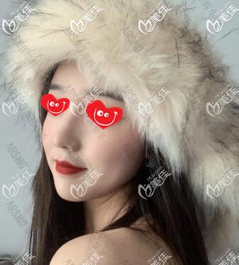 在长沙华韩华美做鼻整形术后60天效果图