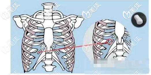 肋软骨隆鼻取材示意图