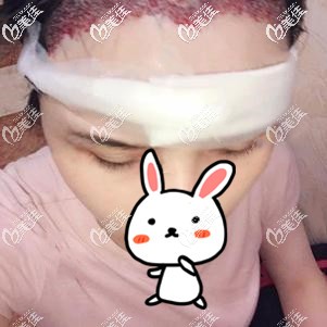 发际线种植术后即刻红肿 发际线种植术后即刻红肿