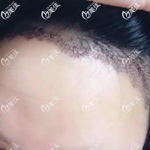 种植发际线术后10天结痂 种植发际线术后10天结痂