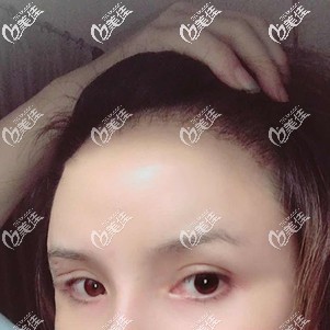 发际线种植术后37天生长出新毛发 发际线种植术后37天生长出新毛发