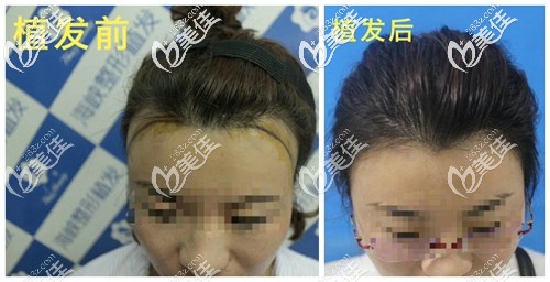 我做发际线种植四个月的效果 我做发际线种植四个月的效果