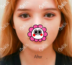 这是我在泰国做切开双眼皮的手术经历,顺便和你说说泰国哪家做双眼皮好