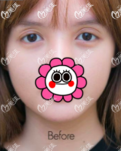 我在泰国做双眼皮前 我在泰国做双眼皮前