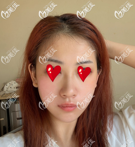 西安米兰柏羽自体脂肪填充面部术后第十五天