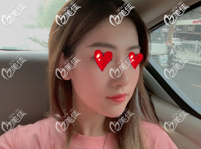 西安米兰柏羽自体脂肪填充面部术后第20天