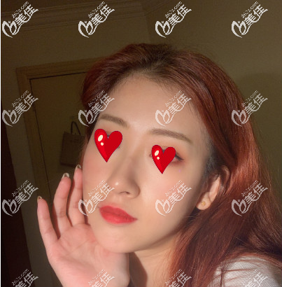 西安米兰柏羽自体脂肪填充面部术后30天