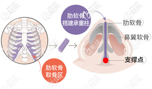 广州佳人李增产肋软骨隆鼻图片 广州佳人李增产肋软骨隆鼻图片