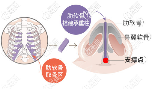 广州佳人李增产肋软骨隆鼻图片