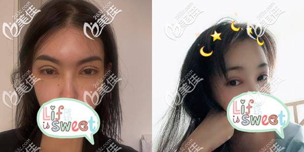 切开双眼皮术后5天,肿到怀疑人生 切开双眼皮术后5天,肿到怀疑人生