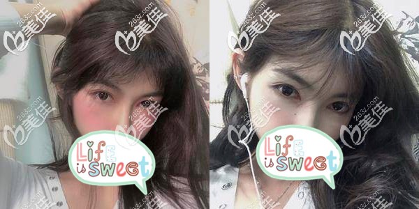 成都东篱医院徐墩全切双眼皮1个月效果图 成都东篱医院徐墩全切双眼皮1个月效果图