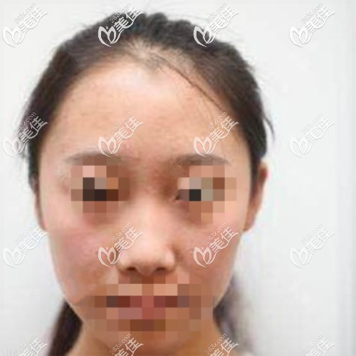 做肋骨鼻术前素颜照片 做肋骨鼻术前素颜照片